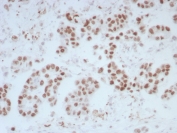 IHC staining of FFPE human bladder tissue with ERCC1 antibody (clone ERCC1/7597). HIER: boil tissue sections in pH 9 10mM Tris with 1mM EDTA for 20 min and allow to cool before testing.
