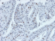 IHC staining of FFPE human tumor of unknown origin with Interferon regulatory factor 3 antibody (clone PCRP-IRF3-4D7). HIER: boil tissue sections in pH 9 10mM Tris with 1mM EDTA for 20 min and allow to cool before testing.