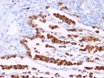 IHC staining of FFPE human lung adenocarcinoma tissue with recombinant NAPSA antibody antibody (clone rNAPSA/7239) at 2ug/ml. HIER: boil tissue sections in pH 9 10mM Tris with 1mM EDTA for 20 min and allow to cool before testing.