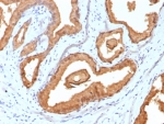 IHC staining of FFPE human prostate carcinoma tissue with Prostate Specific Antigen antibody (clone rKLK3/6947). HIER: boil tissue sections in pH 9 10mM Tris with 1mM EDTA for 20 min and allow to cool before testing.