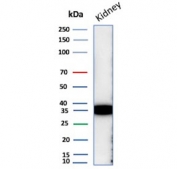 IHC staining of FFPE human lung adenocarcinoma tissue with NAPSA antibody (clone NAPSA/7165R) at 2ug/ml. HIER: boil tissue sections in pH 9 10mM Tris with 1mM EDTA for 20 min and allow to cool before testing.