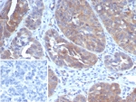 IHC staining of FFPE human ovarian cancer tissue with GLCLR antibody (clone GCLM/4069). Inset: PBS used in place of primary Ab (secondary Ab negative control). HIER: boil tissue sections in pH 9 10mM Tris with 1mM EDTA for 20 min and allow to cool before testing.
