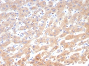 IHC staining of FFPE human hepatocellular carcinoma tissue with Ob-R antibody (clone LEPR/4545). HIER: boil tissue sections in pH 9 10mM Tris with 1mM EDTA for 20 min and allow to cool before testing.