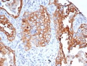 IHC staining of FFPE human lung tissue with L1TD1 antibody (clone L1TD1/7941). HIER: boil tissue sections in pH 9 10mM Tris with 1mM EDTA for 20 min and allow to cool before testing.