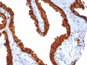 IHC staining of FFPE human prostate carcinoma tissue with TACSTD2 antibody (clone TACSTD2/7348R). HIER: boil tissue sections in pH 9 10mM Tris with 1mM EDTA for 20 min and allow to cool before testing.