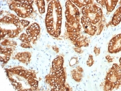 IHC staining of FFPE human prostate carcinoma tissue with TROP2 antibody (clone TACSTD2/7349R). HIER: boil tissue sections in pH 9 10mM Tris with 1mM EDTA for 20 min and allow to cool before testing.