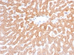 IHC staining of FFPE human hepatocellular carcinoma tissue with recombinant SDHB antibody (clone rSDHB/6948). HIER: boil tissue sections in pH 9 10mM Tris with 1mM EDTA for 20 min and allow to cool before testing.