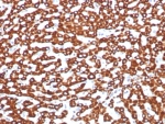 IHC staining of FFPE human hepatocellular carcinoma tissue with Succinate dehydrogenase B antibody (clone SDHB/8974R). HIER: boil tissue sections in pH 9 10mM Tris with 1mM EDTA for 20 min and allow to cool before testing.