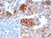 IHC staining of FFPE human ovarian carcinoma tissue with SLC2A1 antibody (clone GLUT1/7308). Inset: PBS used in place of primary Ab (secondary Ab negative control). HIER: boil tissue sections in pH 9 10mM Tris with 1mM EDTA for 20 min and allow to cool before testing.