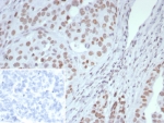 IHC staining of FFPE human ovarian cancer tissue with ARID1A antibody (clone ARID1A/7735). Inset: PBS used in place of primary Ab (secondary Ab negative control). HIER: boil tissue sections in pH 9 10mM Tris with 1mM EDTA for 20 min and allow to cool before testing.