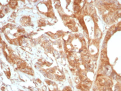 Glycoprotein 36 Antibody Prostate IHC. Immunohistochemistry analysis of Glycoprotein 36 / PDPN expression in FFPE human prostate tissue using recombinant Glycoprotein 36 antibody, clone PDPN/8875R. HRP-DAB brown staining is observed in stromal and perivascular regions with membranous and cytoplasmic localization, while glandular epithelial cells show comparatively reduced signal; nuclei are counterstained blue. This Glycoprotein 36 antibody highlights PDPN-associated stromal compartments consistent with its known distribution. Antigen retrieval was performed by boiling sections in 10 mM Tris buffer with 1 mM EDTA, pH 9, for 20 min followed by cooling at room temperature.