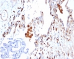 IHC staining of FFPE human lung adenocarcinoma tissue with S100A4 antibody (clone S100A4/6995). Inset: PBS used in place of primary Ab (secondary Ab negative control). HIER: boil tissue sections in pH 9 10mM Tris with 1mM EDTA for 20 min and allow to cool before testing.