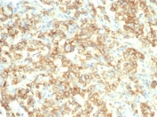 IHC staining of FFPE human bladder tissue with S100A14 antibody (clone S100A14/7403). HIER: boil tissue sections in pH 9 10mM Tris with 1mM EDTA for 20 min and allow to cool before testing.