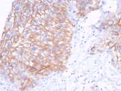 IHC staining of FFPE human bladder tissue with S100A14 antibody (clone S100A14/7401). HIER: boil tissue sections in pH 9 10mM Tris with 1mM EDTA for 20 min and allow to cool before testing.