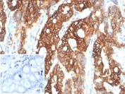 IHC staining of FFPE human colon carcinoma tissue with S100A14 antibody (clone S100A14/7401). Inset: PBS used in place of primary Ab (secondary Ab negative control). HIER: boil tissue sections in pH 9 10mM Tris with 1mM EDTA for 20 min and allow to cool before testing.