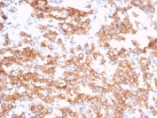 IHC staining of FFPE human bladder tissue with S100 calcium-binding protein A14 antibody (clone S100A14/7402). HIER: boil tissue sections in pH 9 10mM Tris with 1mM EDTA for 20 min and allow to cool before testing.