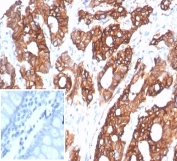 IHC staining of FFPE human colon carcinoma tissue with S100 calcium-binding protein A14 antibody (clone S100A14/7402). Inset: PBS used in place of primary Ab (secondary Ab negative control). HIER: boil tissue sections in pH 9 10mM Tris with 1mM EDTA for 20 min and allow to cool before testing.
