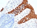 IHC staining of FFPE human colon carcinoma tissue with S100A16 antibody (clone S100A16/7412). Inset: PBS used in place of primary Ab (secondary Ab negative control). HIER: boil tissue sections in pH 9 10mM Tris with 1mM EDTA for 20 min and allow to cool before testing.