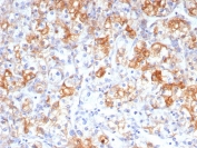 IHC staining of FFPE human renal cell carcinoma tissue with COX2 antibody (clone rCOX2/6996). HIER: boil tissue sections in pH 9 10mM Tris with 1mM EDTA for 20 min and allow to cool before testing.