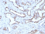 IHC staining of FFPE human prostate tissue with SLC45A3 antibody (clone SLC45A3/7653). HIER: boil tissue sections in pH 9 10mM Tris with 1mM EDTA for 20 min and allow to cool before testing.