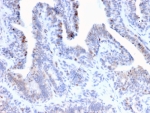 IHC staining of FFPE human prostate cancer tissue with NR5A2 antibody (clone PCRP-NR5A2-1B8). HIER: boil tissue sections in pH 9 10mM Tris with 1mM EDTA for 20 min and allow to cool before testing.