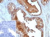 IHC staining of FFPE human prostate cancer tissue with Interleukin 10 antibody (clone IL10/8711). Inset: PBS used in place of primary Ab (secondary Ab negative control). HIER: boil tissue sections in pH 9 10mM Tris with 1mM EDTA for 20 min and allow to cool before testing.