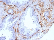 IHC staining of FFPE human colon cancer tissue with CD34 antibody (clone rHPCA1/8573). HIER: boil tissue sections in pH 9 10mM Tris with 1mM EDTA for 20 min and allow to cool before testing.