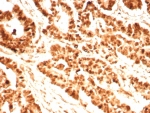 IHC staining of FFPE human prostate tissue with PCNA antibody (clone PCNA/8696R). Inset: PBS used in place of primary Ab (secondary Ab negative control). HIER: boil tissue sections in pH 9 10mM Tris with 1mM EDTA for 20 min and allow to cool before testing.