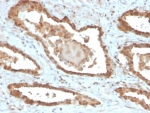 IHC staining of FFPE human prostate tissue with MIF antibody (clone MIF/6277). HIER: boil tissue sections in pH 9 10mM Tris with 1mM EDTA for 20 min and allow to cool before testing.