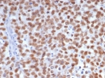 IHC staining of FFPE human seminoma tissue with Sal-like 4 antibody (clone SALL4/7802). HIER: boil tissue sections in pH 9 10mM Tris with 1mM EDTA for 20 min and allow to cool before testing.