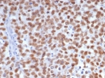 IHC staining of FFPE human seminoma tissue with Sal-like 4 antibody (clone SALL4/7802R). HIER: boil tissue sections in pH 9 10mM Tris with 1mM EDTA for 20 min and allow to cool before testing.