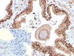 IHC staining of FFPE human prostate tissue with SOX18 antibody (clone SOX18/3271). Inset: PBS used in place of primary Ab (secondary Ab negative control). HIER: boil tissue sections in pH 9 10mM Tris with 1mM EDTA for 20 min and allow to cool before testing.