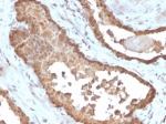 IHC staining of FFPE human prostate tissue with MIF antibody (clone MIF/6279). HIER: boil tissue sections in pH 9 10mM Tris with 1mM EDTA for 20 min and allow to cool before testing.