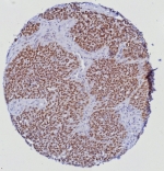 IHC staining of FFPE human prostate tissue with ETS-related gene antibody (clone ERG/6980) at 2ug/ml. HIER: boil tissue sections in pH 9 10mM Tris with 1mM EDTA for 20 min and allow to cool before testing.
