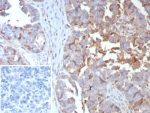 IHC staining of FFPE human ovarian cancer tissue with MX1 antibody (clone MX1/7529). Inset: PBS used in place of primary Ab (secondary Ab negative control). HIER: boil tissue sections in pH 9 10mM Tris with 1mM EDTA for 20 min and allow to cool before testing.