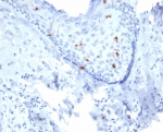 IHC staining of FFPE human skin tissue with Langerin antibody (clone LGRN/7430). HIER: boil tissue sections in pH 9 10mM Tris with 1mM EDTA for 20 min and allow to cool before testing.