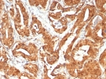 IHC staining of FFPE human prostate tissue with MIF antibody (clone MIF/6281). HIER: boil tissue sections in pH 9 10mM Tris with 1mM EDTA for 20 min and allow to cool before testing.