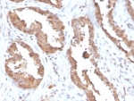 IHC staining of FFPE human prostate tissue with Glycosylation inhibiting factor antibody (clone MIF/6278). HIER: boil tissue sections in pH 9 10mM Tris with 1mM EDTA for 20 min and allow to cool before testing.