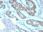 IHC staining of FFPE human prostate tissue with BAF47 antibody (clone rINI1/8850) Inset: PBS used in place of primary Ab (secondary Ab negative control). HIER: boil tissue sections in pH 9 10mM Tris with 1mM EDTA for 20 min and allow to cool before testing.