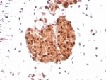 IHC staining of FFPE human sarcoma tissue with INI-1 antibody (clone SMARCB1/8851R) HIER: boil tissue sections in pH 9 10mM Tris with 1mM EDTA for 20 min and allow to cool before testing.
