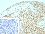 IHC staining of FFPE human ovarian cancer tissue with SMARCB1 antibody (clone INI1/8935R) Inset: PBS used in place of primary Ab (secondary Ab negative control). HIER: boil tissue sections in pH 9 10mM Tris with 1mM EDTA for 20 min and allow to cool before testing.