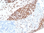 IHC staining of FFPE human ovarian carcinoma tissue with MSH6 antibody (clone MSH6/7064R). Inset: PBS used in place of primary Ab (secondary Ab negative control). HIER: boil tissue sections in pH 9 10mM Tris with 1mM EDTA for 20 min and allow to cool before testing.