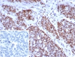 IHC staining of FFPE human small intestine tissue with recombinant MSH6 antibody (clone rMSH6/8337). Inset: PBS used in place of primary Ab (secondary Ab negative control). HIER: boil tissue sections in pH 9 10mM Tris with 1mM EDTA for 20 min and allow to cool before testing.