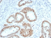 IHC staining of FFPE human colon carcinoma tissue with SATB2 antibody (clone SATB2/7110). Strong nuclear staining is observed at 2ug/ml. HIER: boil tissue sections in pH 9 10mM Tris with 1mM EDTA for 20 min and allow to cool before testing.