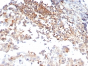 IHC staining of FFPE human ovarian carcinoma tissue with Luteinizing Hormone Receptor antibody (clone LHCGR/7399). HIER: boil tissue sections in pH 9 10mM Tris with 1mM EDTA for 20 min and allow to cool before testing.