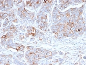 IHC staining of FFPE human ovarian carcinoma tissue with Syndecan-1 antibody (clone SDC1/7178). HIER: boil tissue sections in pH 9 10mM Tris with 1mM EDTA for 20 min and allow to cool before testing.