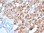 IHC staining of FFPE human thyroid carcinoma tissue with Thyroid Peroxidase antibody (clone TPO/7088R). Inset: PBS used in place of primary Ab (secondary Ab negative control). HIER: boil tissue sections in pH 9 10mM Tris with 1mM EDTA for 20 min and allow to cool before testing.
