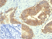 IHC staining of FFPE human colon tissue with EpCAM / CD326 antibody (clone rEGP40/7334). Inset: PBS used in place of primary Ab (secondary Ab negative control). HIER: boil tissue sections in pH 9 10mM Tris with 1mM EDTA for 20 min and allow to cool before testing.