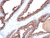 IHC staining of FFPE human prostate cancer tissue with CD26 antibody (clone DPP4/7415). HIER: boil tissue sections in pH 9 10mM Tris with 1mM EDTA for 20 min and allow to cool before testing.