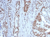 IHC staining of FFPE human colon tissue with Nucleolin antibody (clone NCL/7339). HIER: boil tissue sections in pH 9 10mM Tris with 1mM EDTA for 20 min and allow to cool before testing.